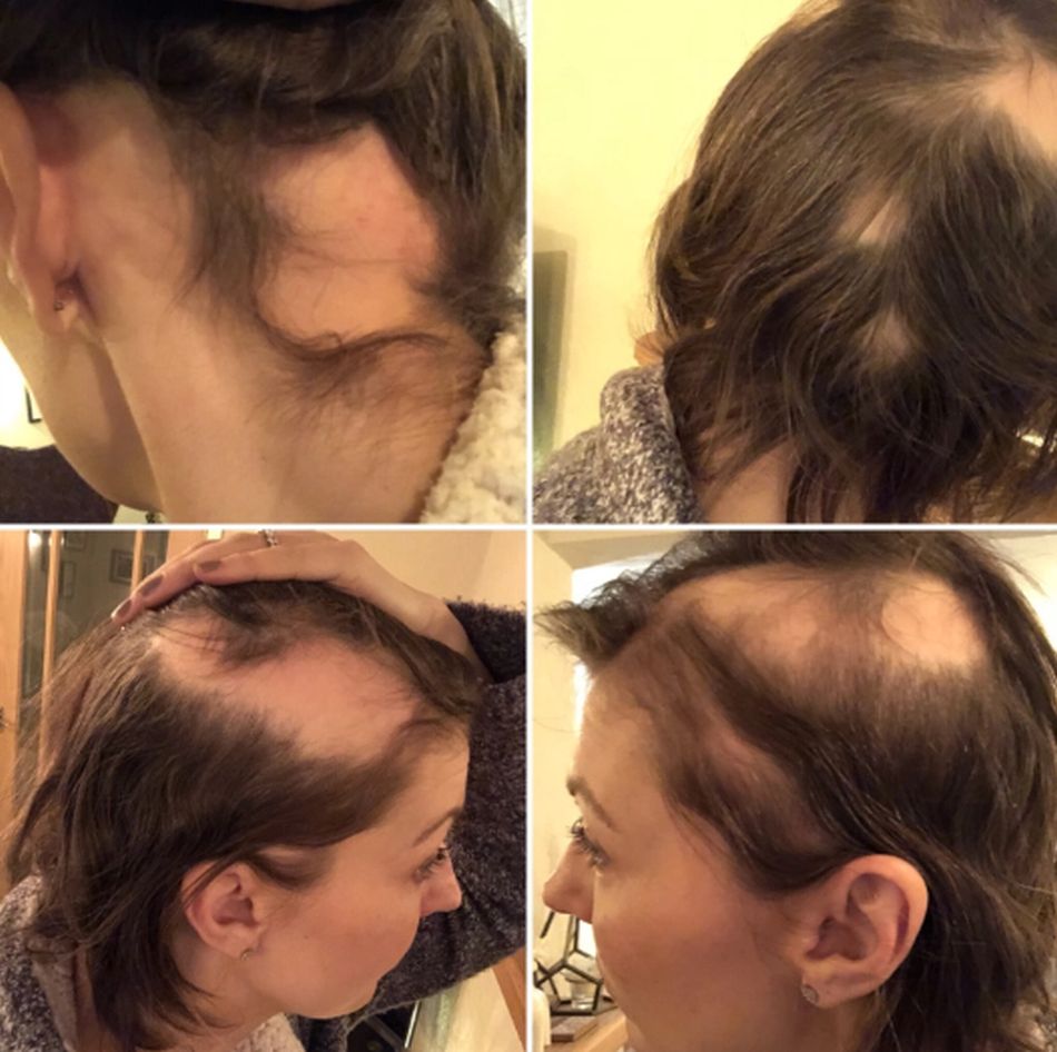 La mujer poco a poco empezó a perder cabello. (Foto: Blog Hair Loss Diaries)