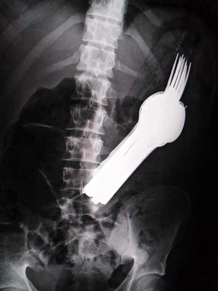 Tras realizar los exámenes necesarios, incluyendo rayos X y un telescopio abdominal, se reveló la existencia de una gran masa de metal dentro de la cavidad estomacal del joven. (Foto: Facebook Mansoura University 